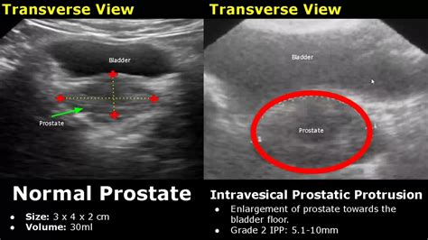The volume of the prostate progressively increases with age, however, the rate of growth was found to be decreasing with increasing age. . Normal prostate volume ultrasound